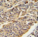 CTSE / Cathepsin E Antibody - CTSE Antibody IHC of formalin-fixed and paraffin-embedded human lung carcinoma followed by peroxidase-conjugated secondary antibody and DAB staining.