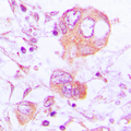 CTSH / Cathepsin H Antibody - Immunohistochemical analysis of Cathepsin H staining in human lung cancer formalin fixed paraffin embedded tissue section. The section was pre-treated using heat mediated antigen retrieval with sodium citrate buffer (pH 6.0). The section was then incubated with the antibody at room temperature and detected using an HRP conjugated compact polymer system. DAB was used as the chromogen. The section was then counterstained with hematoxylin and mounted with DPX.