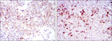 CTTN / Cortactin Antibody - IHC of paraffin-embedded cervical cancer tissues (left) and tonsil tissues (right) using CTTN mouse monoclonal antibody with DAB staining.