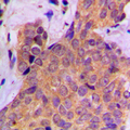 CTTN / Cortactin Antibody - Immunohistochemical analysis of Cortactin (pY421) staining in human breast cancer formalin fixed paraffin embedded tissue section. The section was pre-treated using heat mediated antigen retrieval with sodium citrate buffer (pH 6.0). The section was then incubated with the antibody at room temperature and detected using an HRP conjugated compact polymer system. DAB was used as the chromogen. The section was then counterstained with hematoxylin and mounted with DPX.