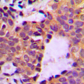 CTTN / Cortactin Antibody - Immunohistochemical analysis of Cortactin (pY466) staining in human breast cancer formalin fixed paraffin embedded tissue section. The section was pre-treated using heat mediated antigen retrieval with sodium citrate buffer (pH 6.0). The section was then incubated with the antibody at room temperature and detected using an HRP conjugated compact polymer system. DAB was used as the chromogen. The section was then counterstained with hematoxylin and mounted with DPX.