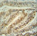 CUL5 / Cullin-5 Antibody - CUL5 Antibody immunohistochemistry of formalin-fixed and paraffin-embedded human colon carcinoma followed by peroxidase-conjugated secondary antibody and DAB staining.
