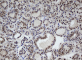 Cullin 4B / CUL4B Antibody - IHC of paraffin-embedded Carcinoma of Human thyroid tissue using anti-CUL4B mouse monoclonal antibody.