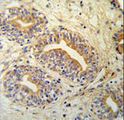 CWC15 Antibody - CWC15 Antibody IHC of formalin-fixed and paraffin-embedded prostate carcinoma followed by peroxidase-conjugated secondary antibody and DAB staining.