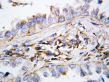 CXCL9 / MIG Antibody - MIG / CXCL9 antibody. IHC(P): Human Lung Cancer Tissue.