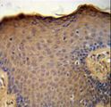 CXCL9 / MIG Antibody - CXCL9 Antibody immunohistochemistry of formalin-fixed and paraffin-embedded human skin carcinoma followed by peroxidase-conjugated secondary antibody and DAB staining.
