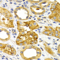 CXCR3 Antibody - Immunohistochemistry of paraffin-embedded human kidney cancer tissue.