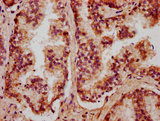 CXorf36 Antibody - Immunohistochemistry Dilution at 1:400 and staining in paraffin-embedded human prostate cancer performed on a Leica BondTM system. After dewaxing and hydration, antigen retrieval was mediated by high pressure in a citrate buffer (pH 6.0). Section was blocked with 10% normal Goat serum 30min at RT. Then primary antibody (1% BSA) was incubated at 4°C overnight. The primary is detected by a biotinylated Secondary antibody and visualized using an HRP conjugated SP system.