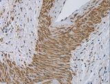 CYB5A / Cytochrome b5 Antibody - Immunohistochemistry of paraffin-embedded Human cervical cancer using CYB5A Polyclonal Antibody at dilution of 1:30.