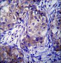 CYP1A1 Antibody - CYP1A1 Antibody immunohistochemistry of formalin-fixed and paraffin-embedded human breast carcinoma followed by peroxidase-conjugated secondary antibody and DAB staining.