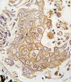 CYP1A1 Antibody - Formalin-fixed and paraffin-embedded human lung carcinoma tissue reacted with CYP1A1 antibody , which was peroxidase-conjugated to the secondary antibody, followed by DAB staining. This data demonstrates the use of this antibody for immunohistochemistry; clinical relevance has not been evaluated.