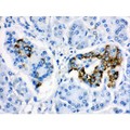 CYP24 / CYP24A1 Antibody - CYP24A1 antibody IHC-paraffin. IHC(P): Human Pancreatic Cancer Tissue.