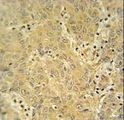 CYP2A7 Antibody - CYP2A7 antibody immunohistochemistry of formalin-fixed and paraffin-embedded human hepatocarcinoma followed by peroxidase-conjugated secondary antibody and DAB staining.