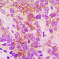 CYP2B6 Antibody - Immunohistochemical analysis of Cytochrome P450 2B6 staining in human breast cancer formalin fixed paraffin embedded tissue section. The section was pre-treated using heat mediated antigen retrieval with sodium citrate buffer (pH 6.0). The section was then incubated with the antibody at room temperature and detected using an HRP conjugated compact polymer system. DAB was used as the chromogen. The section was then counterstained with hematoxylin and mounted with DPX.