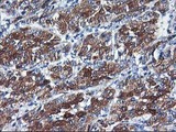 CYP2C9 / Cytochrome P450 2C9 Antibody - IHC of paraffin-embedded Carcinoma of Human liver tissue using anti-CYP2C9 mouse monoclonal antibody.