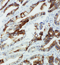 CYP2U1 Antibody - CYP2U1 antibody. IHC(P): Human Intestinal Cancer Tissue.