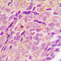 CYP2U1 Antibody - Immunohistochemical analysis of Cytochrome P450 2U1 staining in human breast cancer formalin fixed paraffin embedded tissue section. The section was pre-treated using heat mediated antigen retrieval with sodium citrate buffer (pH 6.0). The section was then incubated with the antibody at room temperature and detected using an HRP conjugated compact polymer system. DAB was used as the chromogen. The section was then counterstained with hematoxylin and mounted with DPX.