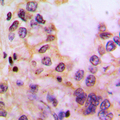 CYP39A1 Antibody - Immunohistochemical analysis of Cytochrome P450 39A1 staining in human liver cancer formalin fixed paraffin embedded tissue section. The section was pre-treated using heat mediated antigen retrieval with sodium citrate buffer (pH 6.0). The section was then incubated with the antibody at room temperature and detected using an HRP conjugated compact polymer system. DAB was used as the chromogen. The section was then counterstained with hematoxylin and mounted with DPX.