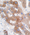 CYP3A5 Antibody - Formalin-fixed and paraffin-embedded human hepatocarcinoma tissue reacted with CYP3A5 antibody , which was peroxidase-conjugated to the secondary antibody, followed by DAB staining. This data demonstrates the use of this antibody for immunohistochemistry; clinical relevance has not been evaluated.