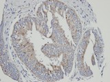 CYP4A11 Antibody - IHC of paraffin-embedded mixed OVCA using CYP4A11 antibody at 1:100 dilution.