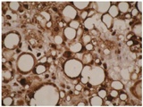 CYP4F11 Antibody - A. IHC of human liposarcoma cells using CYP4F11 antibody (Cytochrome P450 4F11). B. Western blot of CYP4F11 antibody one normal (2) and cancerous (3) kidney cell lysates.