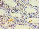 CYP4F12 Antibody - Immunohistochemistry of paraffin-embedded human colon cancer using antibody at 1:100 dilution.