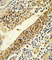 CYP51A1 / CYP51 Antibody - Formalin-fixed and paraffin-embedded human prostate carcinoma reacted with CYP51A1 Antibody , which was peroxidase-conjugated to the secondary antibody, followed by DAB staining. This data demonstrates the use of this antibody for immunohistochemistry; clinical relevance has not been evaluated.