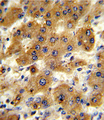 CYP8B1 Antibody - Formalin-fixed and paraffin-embedded human hepatocarcinoma reacted with CYP8B1 Antibody , which was peroxidase-conjugated to the secondary antibody, followed by DAB staining. This data demonstrates the use of this antibody for immunohistochemistry; clinical relevance has not been evaluated.