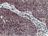 Cystatin SA / CST2 Antibody - IHC of paraffin-embedded Carcinoma of Human bladder tissue using anti-CST2 mouse monoclonal antibody.