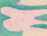 Cytokeratin 5+6+8+17+19 Antibody - IHC of Cytokeratin, MNF116 on an Frozen Basal Cell Carcinoma Tissue
