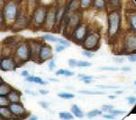 Cytokeratin AE1+AE3 Antibody - IHC of CK AE1 & AE3 on FFPE Breast Carcinoma tissue. This image was taken for the unmodified form of this product. Other forms have not been tested.