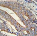DACT1 / DAPPER Antibody - DACT1 antibody immunohistochemistry of formalin-fixed and paraffin-embedded human prostate carcinoma followed by peroxidase-conjugated secondary antibody and DAB staining.