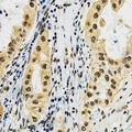 DAT1 / LMO3 Antibody - Immunohistochemical analysis of LMO3 staining in human lung cancer formalin fixed paraffin embedded tissue section. The section was pre-treated using heat mediated antigen retrieval with sodium citrate buffer (pH 6.0). The section was then incubated with the antibody at room temperature and detected with HRP and DAB as chromogen. The section was then counterstained with hematoxylin and mounted with DPX.