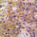 DAXX Antibody - Immunohistochemical analysis of DAXX staining in human breast cancer formalin fixed paraffin embedded tissue section. The section was pre-treated using heat mediated antigen retrieval with sodium citrate buffer (pH 6.0). The section was then incubated with the antibody at room temperature and detected using an HRP conjugated compact polymer system. DAB was used as the chromogen. The section was then counterstained with hematoxylin and mounted with DPX.