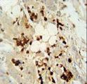 DCAF4L2 Antibody - WDR21C antibody immunohistochemistry of formalin-fixed and paraffin-embedded human colon carcinoma followed by peroxidase-conjugated secondary antibody and DAB staining.