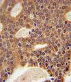 DCLRE1B Antibody - DCLRE1B Antibody immunohistochemistry of formalin-fixed and paraffin-embedded human prostate carcinoma followed by peroxidase-conjugated secondary antibody and DAB staining.