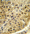 DCT / Dopachrome Tautomerase Antibody - Formalin-fixed and paraffin-embedded human hepatocarcinoma reacted with DCT Antibody , which was peroxidase-conjugated to the secondary antibody, followed by DAB staining. This data demonstrates the use of this antibody for immunohistochemistry; clinical relevance has not been evaluated.