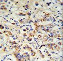 DCT / Dopachrome Tautomerase Antibody - DCT Antibody IHC of formalin-fixed and paraffin-embedded breast carcinoma followed by peroxidase-conjugated secondary antibody and DAB staining.