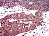 DCTN4 / Dynactin 4 Antibody - IHC of paraffin-embedded ovarian cancer tissues using DCTN4 mouse monoclonal antibody with DAB staining.