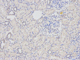 DDB2 Antibody - Immunohistochemistry of paraffin-embedded human kidney cancer using DDB2 antibody at dilution of 1:200 (400x lens).