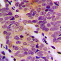 DDH / AKR1C1 Antibody - Immunohistochemical analysis of AKR1C1 staining in human breast cancer formalin fixed paraffin embedded tissue section. The section was pre-treated using heat mediated antigen retrieval with sodium citrate buffer (pH 6.0). The section was then incubated with the antibody at room temperature and detected using an HRP conjugated compact polymer system. DAB was used as the chromogen. The section was then counterstained with hematoxylin and mounted with DPX.
