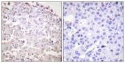 DDIT3 / CHOP Antibody - Immunohistochemistry analysis of paraffin-embedded human breast carcinoma tissue, using GADD153 Antibody. The picture on the right is blocked with the synthesized peptide.