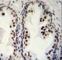 DDX27 Antibody - DDX27 Antibody immunohistochemistry of formalin-fixed and paraffin-embedded human prostate carcinoma followed by peroxidase-conjugated secondary antibody and DAB staining.