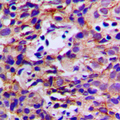 DDX3Y Antibody - Immunohistochemical analysis of DDX3Y staining in human breast cancer formalin fixed paraffin embedded tissue section. The section was pre-treated using heat mediated antigen retrieval with sodium citrate buffer (pH 6.0). The section was then incubated with the antibody at room temperature and detected using an HRP conjugated compact polymer system. DAB was used as the chromogen. The section was then counterstained with hematoxylin and mounted with DPX.
