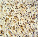DDX49 Antibody - DDX49 Antibody immunohistochemistry of formalin-fixed and paraffin-embedded human breast carcinoma followed by peroxidase-conjugated secondary antibody and DAB staining.