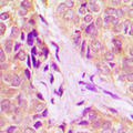 DDX55 Antibody - Immunohistochemical analysis of DDX55 staining in human breast cancer formalin fixed paraffin embedded tissue section. The section was pre-treated using heat mediated antigen retrieval with sodium citrate buffer (pH 6.0). The section was then incubated with the antibody at room temperature and detected using an HRP-conjugated compact polymer system. DAB was used as the chromogen. The section was then counterstained with hematoxylin and mounted with DPX.
