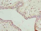 DDX55 Antibody - Immunohistochemistry of paraffin-embedded human breast cancer using antibody at dilution of 1:100.