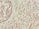 DEFB129 Antibody - Immunohistochemistry of paraffin-embedded human pancreatic cancer using antibody at dilution of 1:100.