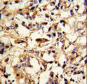 DFNA5 Antibody - Formalin-fixed and paraffin-embedded human breast carcinoma reacted with DFNA5 Antibody , which was peroxidase-conjugated to the secondary antibody, followed by DAB staining. This data demonstrates the use of this antibody for immunohistochemistry; clinical relevance has not been evaluated.