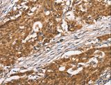 DGAT1 Antibody - Immunohistochemistry of paraffin-embedded Human gastric cancer using DGAT1 Polyclonal Antibody at dilution of 1:40.